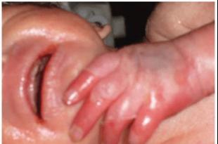 Недоношенные дети: выхаживание и вскармливание в первые дни жизни Особенности выхаживания недоношенных новорожденных